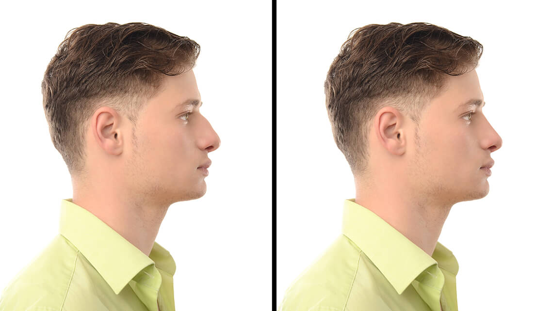 Rhinoplasty for Men