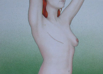 Meme Kanseri Mastektomi