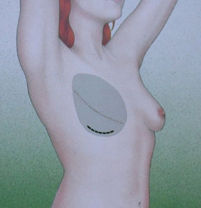 Mastektomi (Meme Kanseri) Sonrası Meme Rekonstrüksiyonu Mastektomi (Meme Kanseri) Sonrası Meme Rekonstrüksiyonu