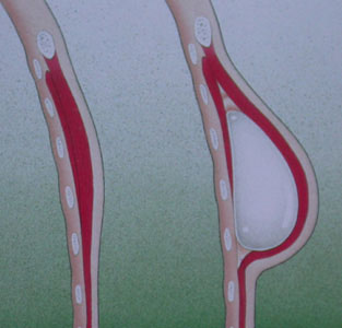 Mastektomi Sonrası Meme Rekonstrüksiyonu Mastektomi Sonrası Meme Rekonstrüksiyonu