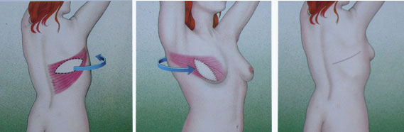 meme kanseri ankara Meme kanseri ankara