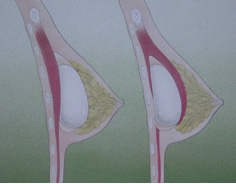 Breast Augmentation Surgery