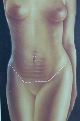 Abdominoplasti Abdominoplasti