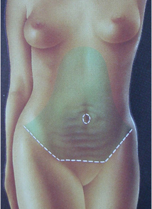 Abdominoplasti ankara Abdominoplasti ankara