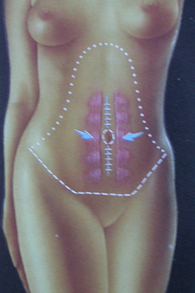 Abdominoplasti ameliyatı Abdominoplasti ameliyatı