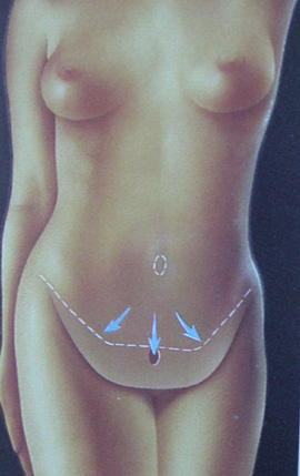 Karın Germe ameliyatı Karın Germe ameliyatı