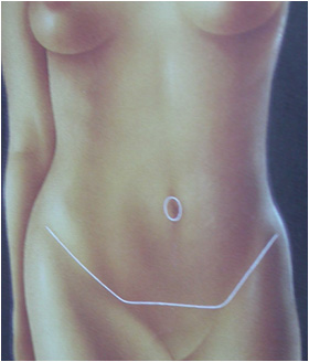 Karın Germe ameliyatı ankara Karın Germe ameliyatı ankara